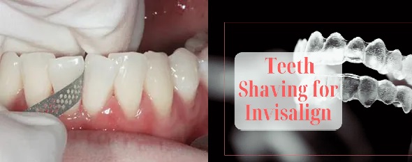 invisalign teeth shaving