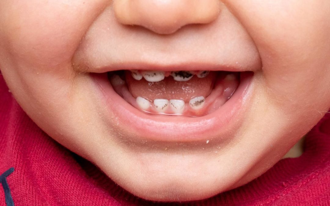 iron stains on toddler teeth