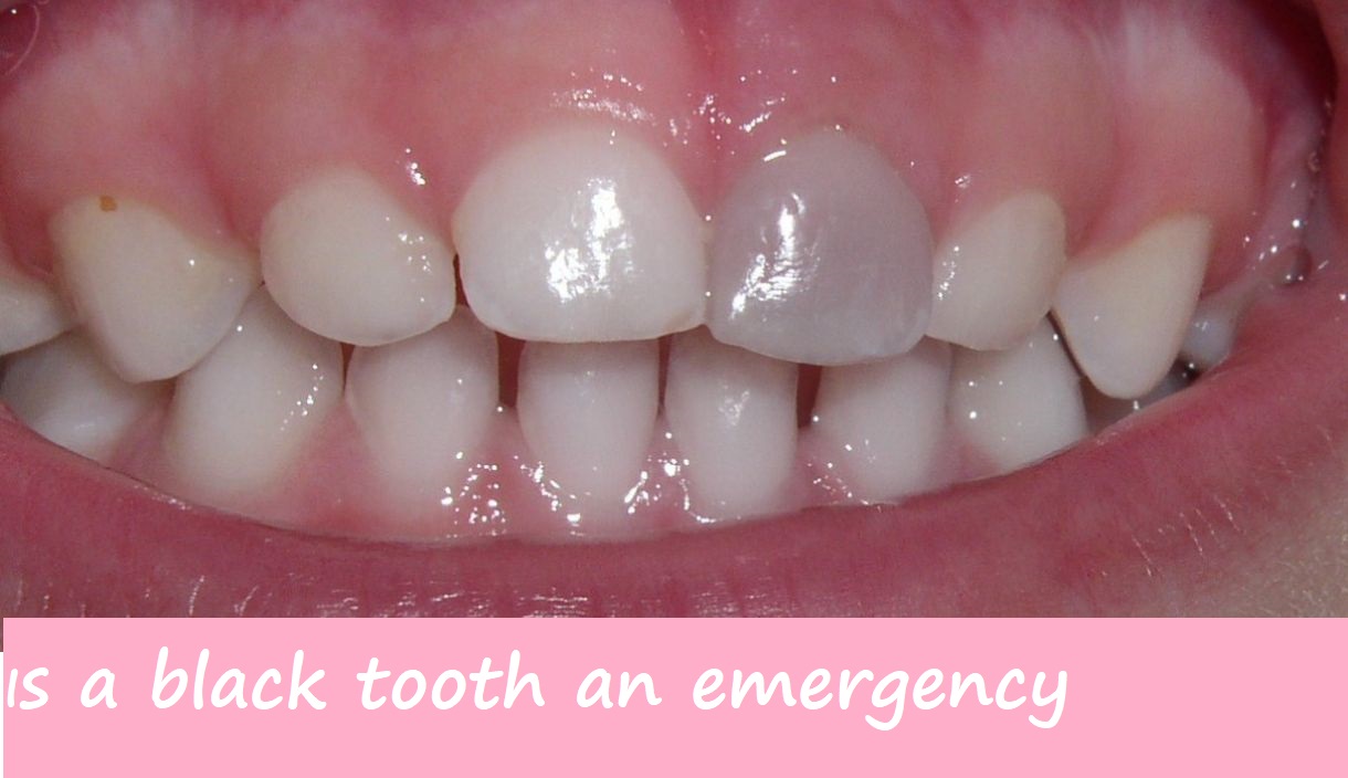 is a black tooth an emergency