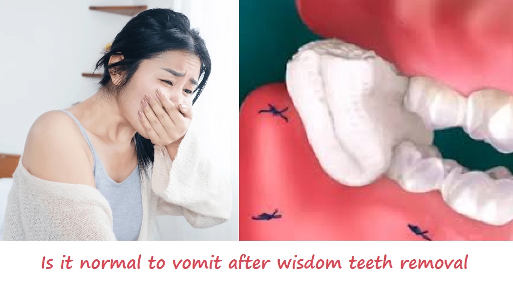 is it normal to vomit after wisdom teeth removal