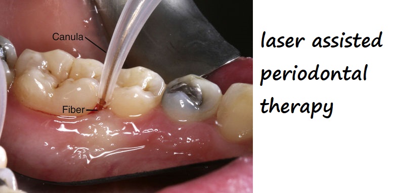 laser assisted periodontal therapy