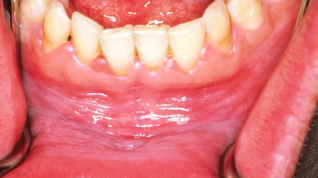 white gums