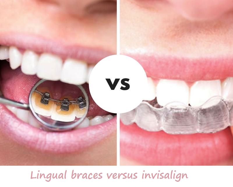 lingual braces versus invisalign