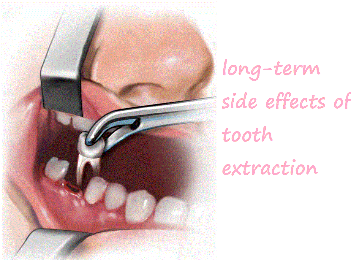 long-term side effects of tooth extraction