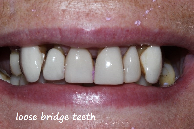 loose bridge teeth