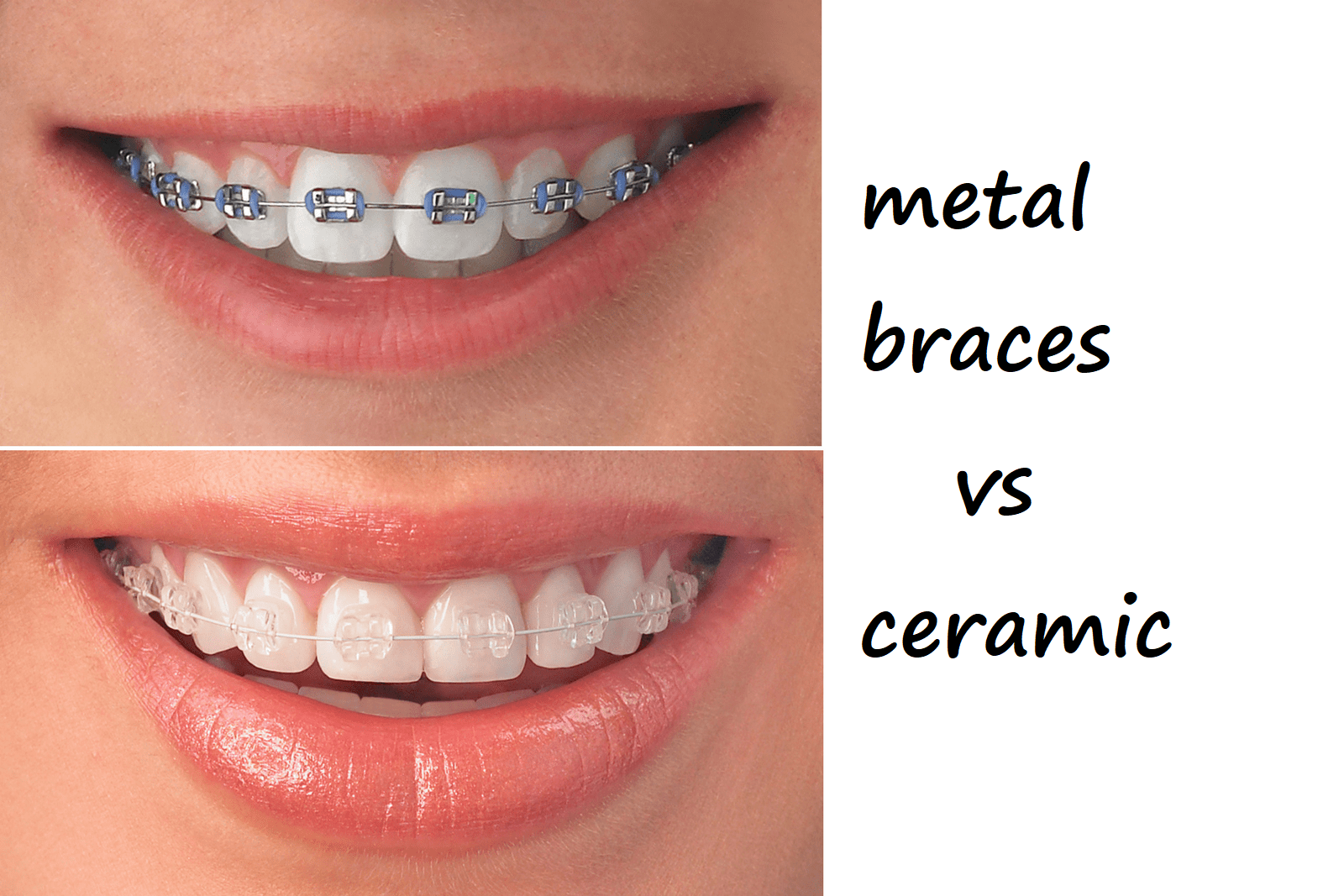 metal braces vs ceramic