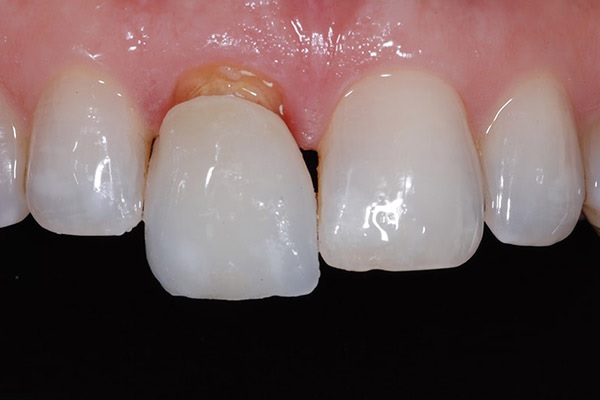 Ceramic front tooth crown