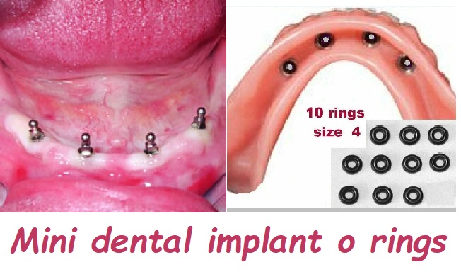 Mini dental implant o rings