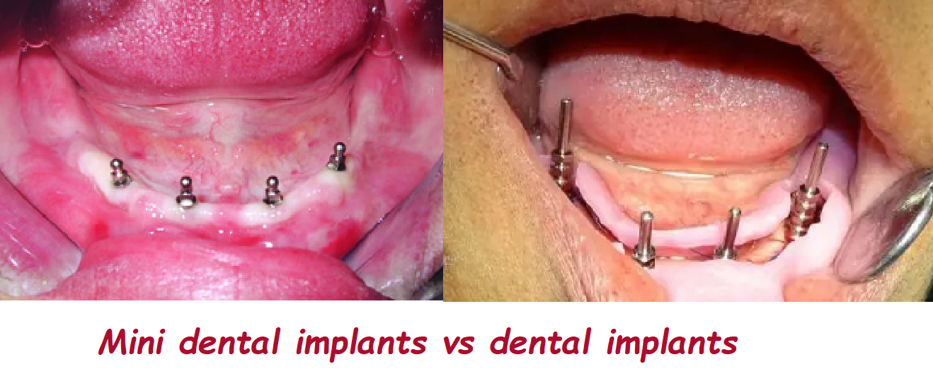 Mini dental implants vs dental implants