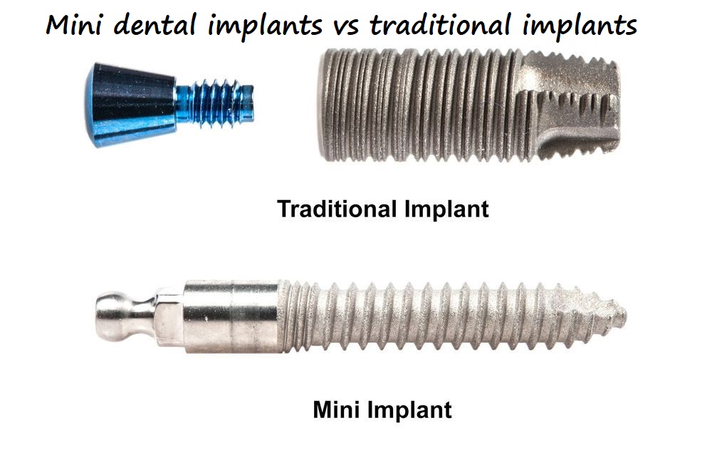 Mini dental implants vs traditional implants