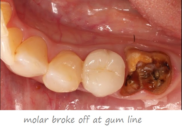 molar broke off at gum line