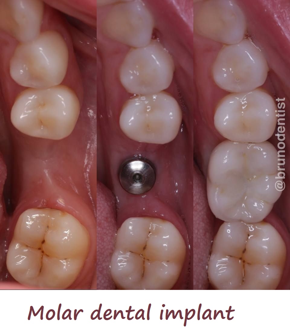 Molar dental implant