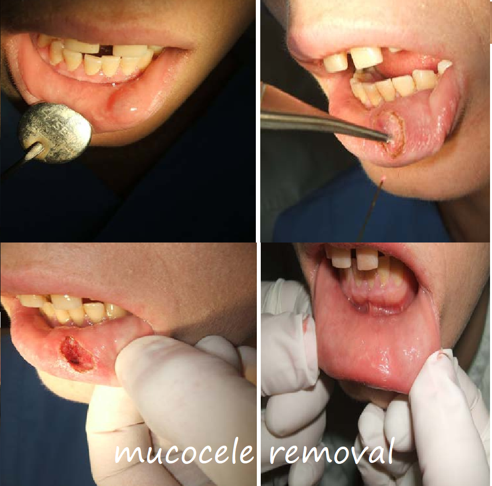 mucocele removal