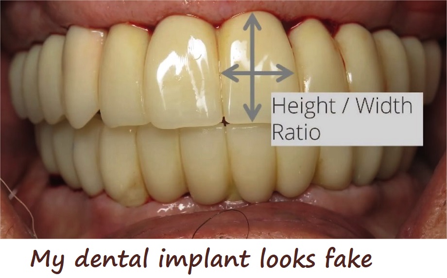 My dental implant looks fake