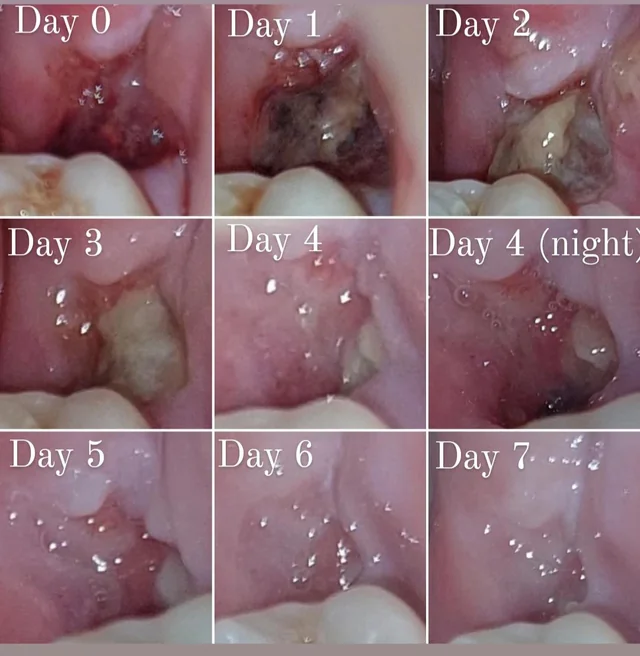 normal socket after tooth extraction