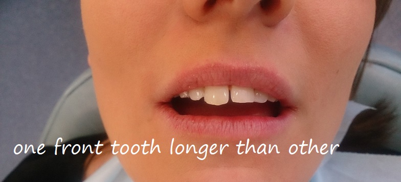 one front tooth longer than other