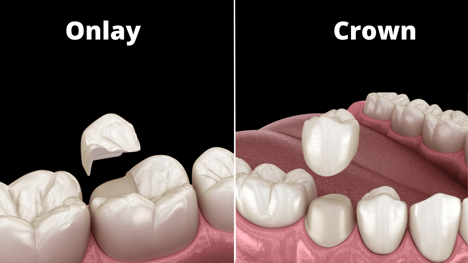 onlay vs crown