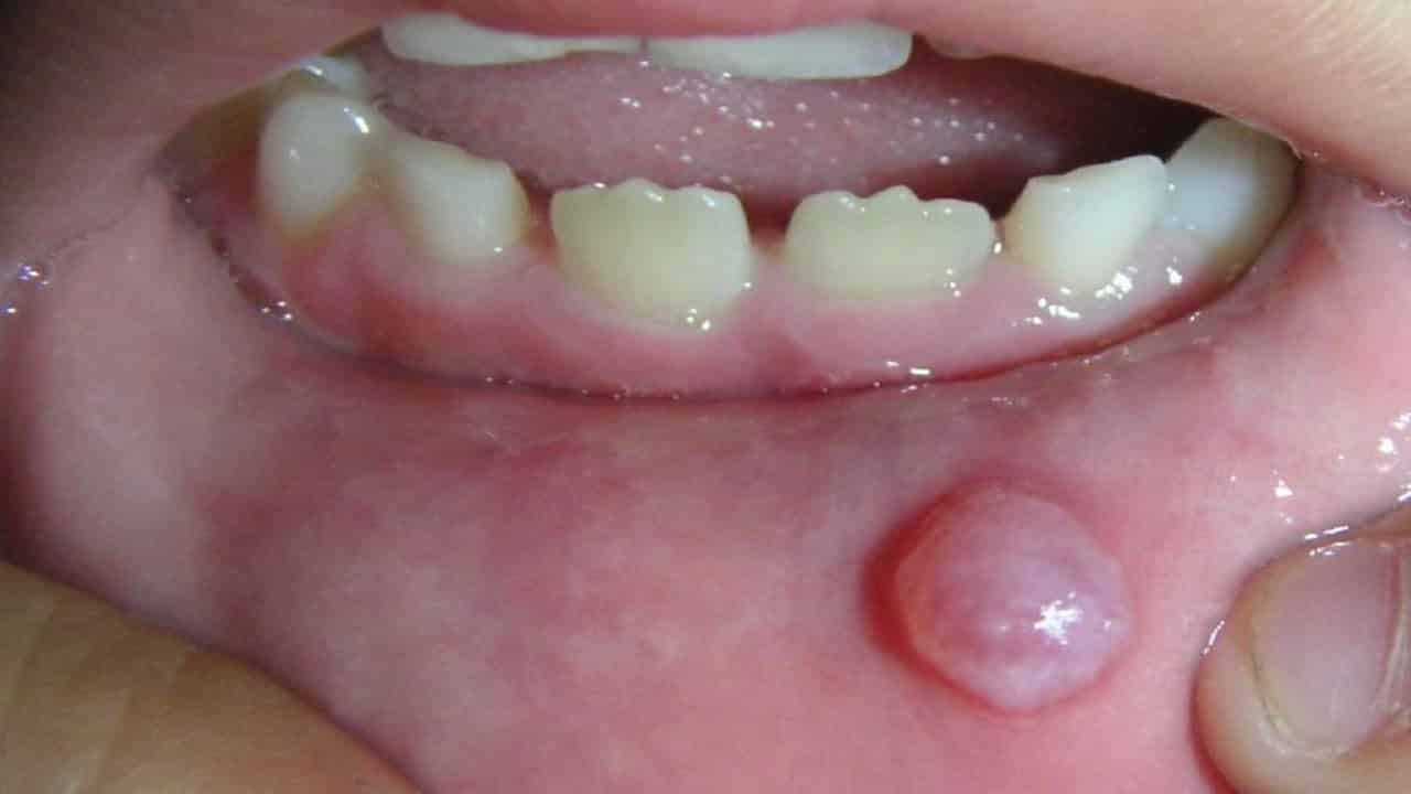 oral mucocele treatments