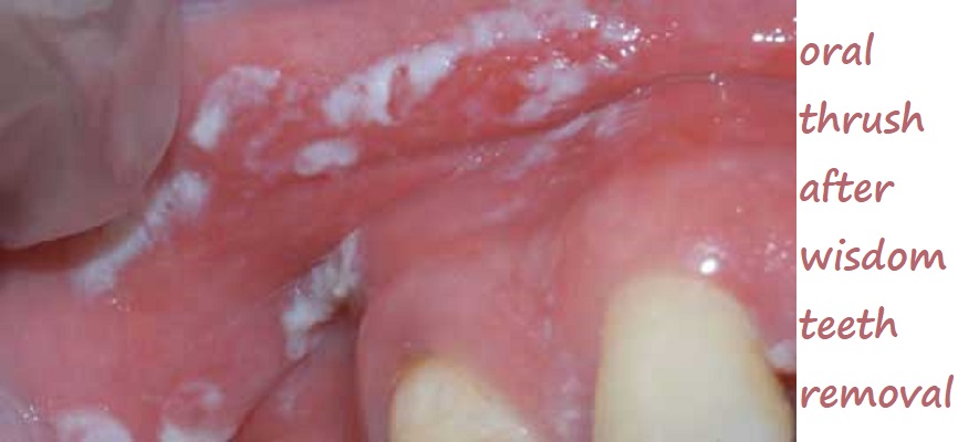 oral thrush after wisdom teeth removal