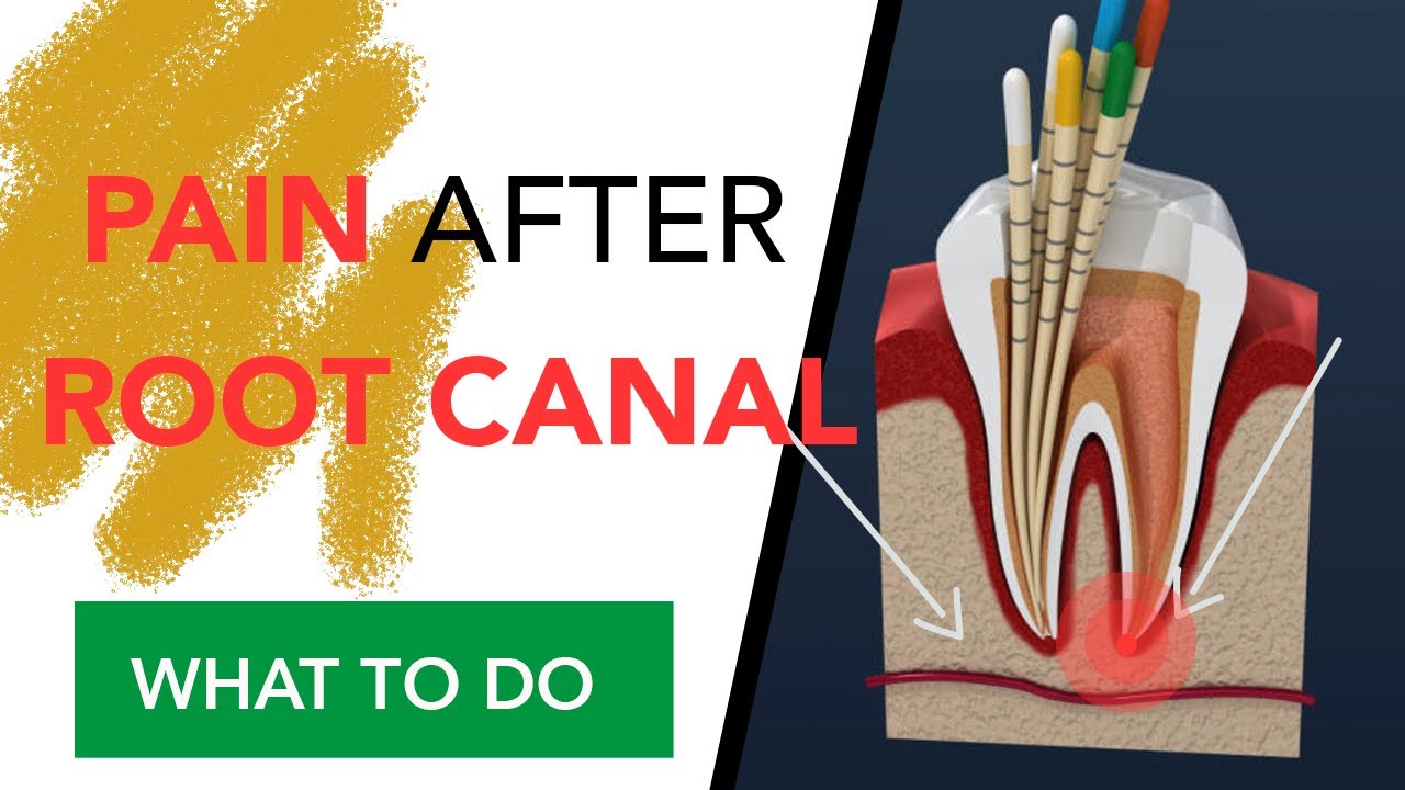 Pain After Root Canal
