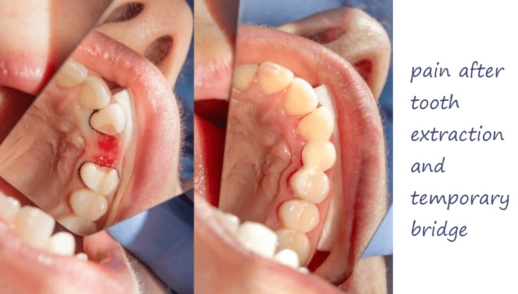 pain after tooth extraction and temporary bridge