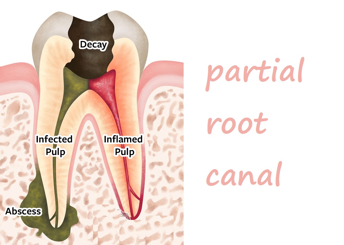 partial root canal