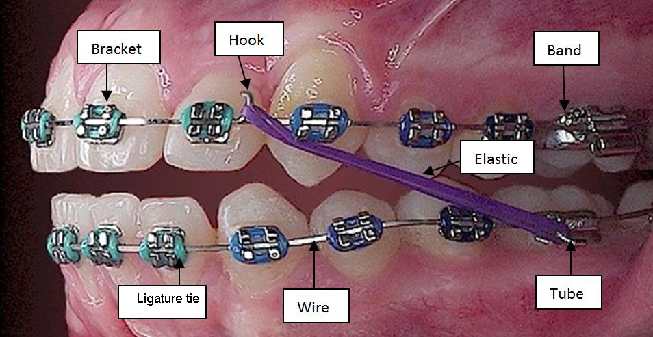 parts of braces