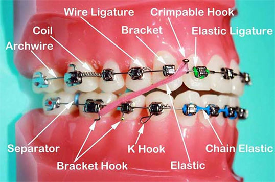 parts of braces