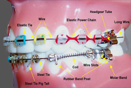 parts of braces