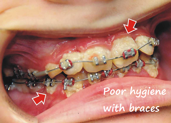 poor hygiene with braces