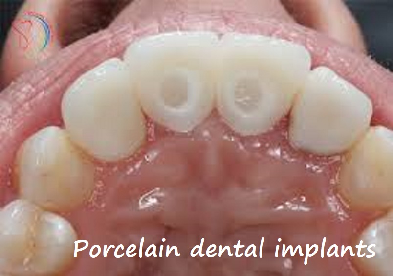 porcelain dental implants