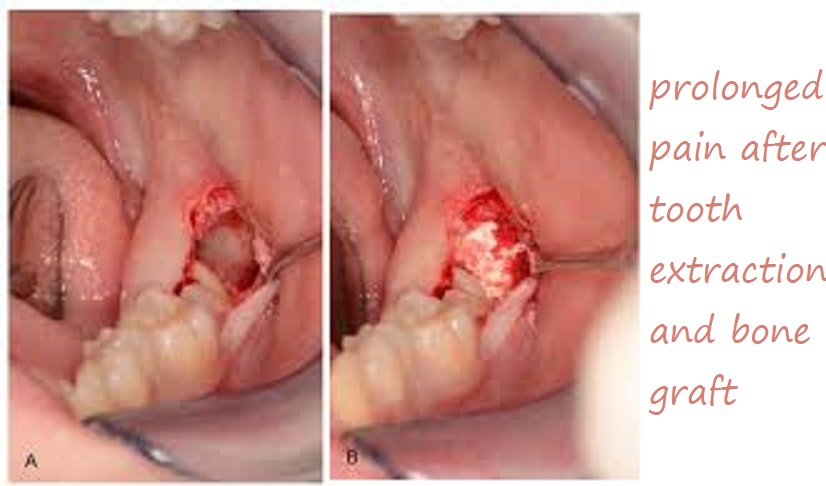 prolonged pain after tooth extraction and bone graft