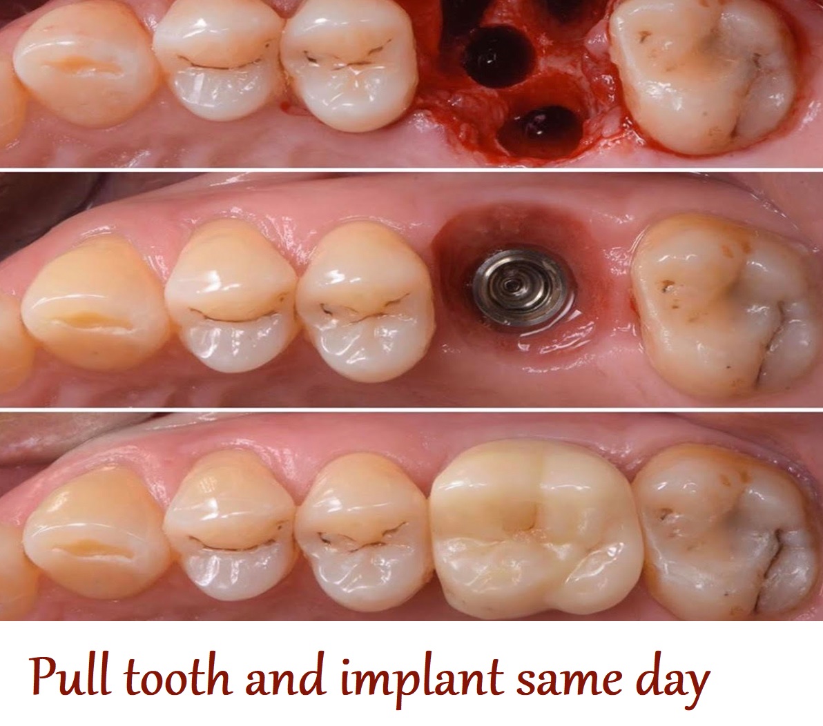 Pull tooth and implant same day