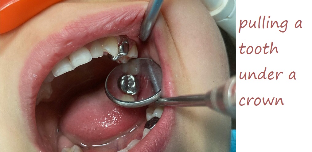 pulling a tooth under a crown