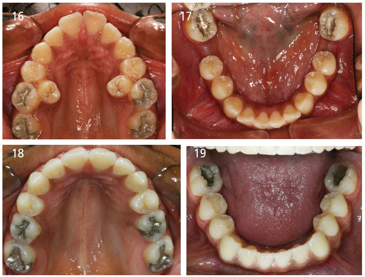 removing molars for braces