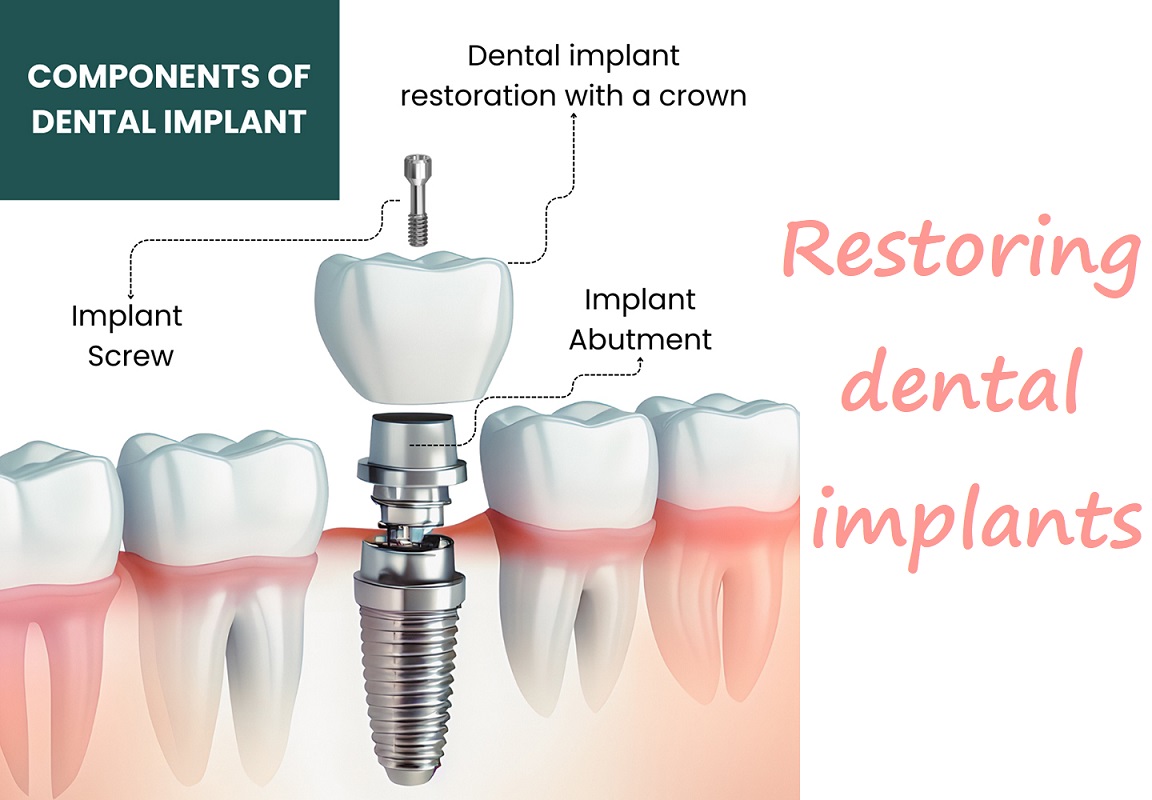 Restoring dental implants