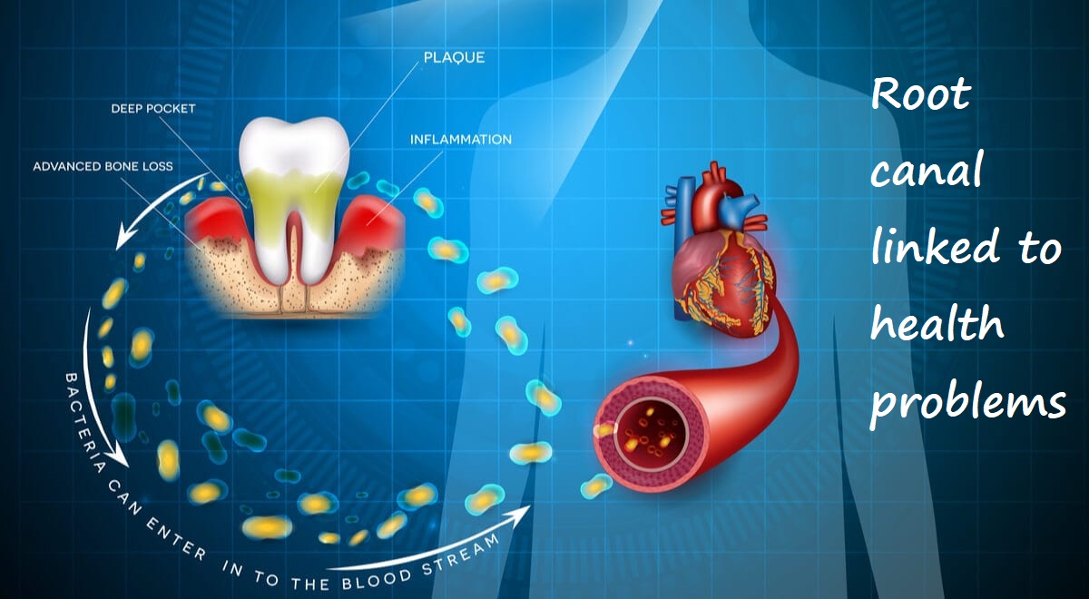 root canal linked to health problems