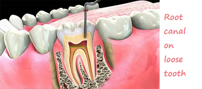 Root canal on loose tooth