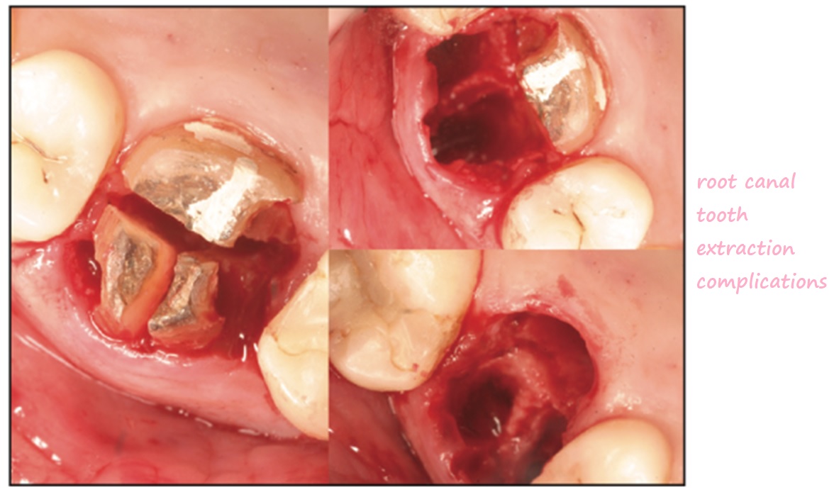 root canal tooth extraction complications