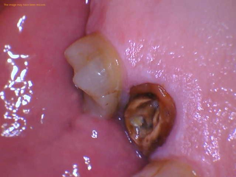 root canal tooth fell out