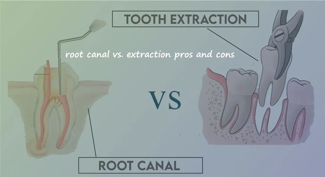 root canal vs. extraction pros and cons