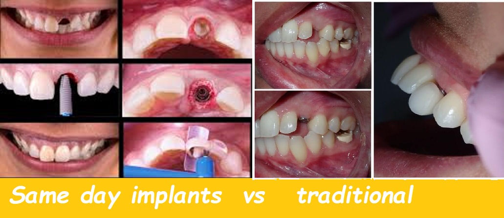 Same day implants vs traditional