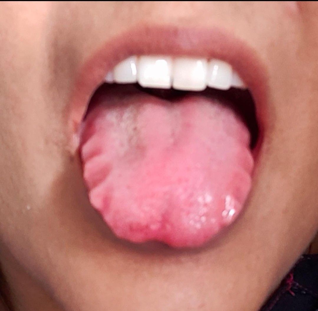 scalloped tongue