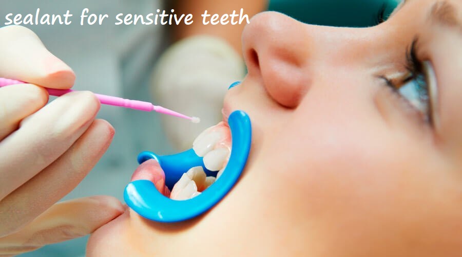 sealant for sensitive teeth