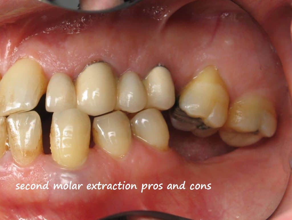 second molar extraction pros and cons