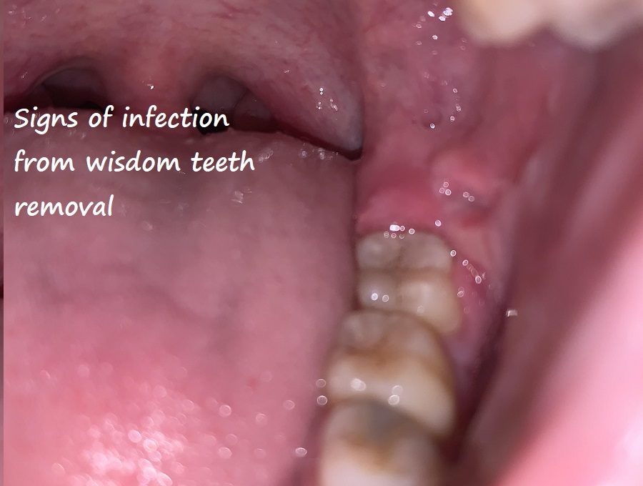 signs of infection from wisdom teeth removal