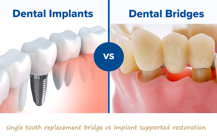 single tooth replacement bridge vs implant supported restoration