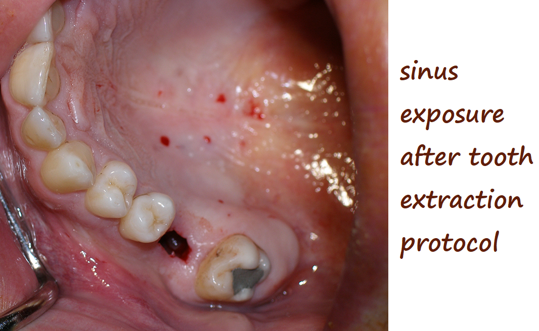 sinus exposure after tooth extraction protocol