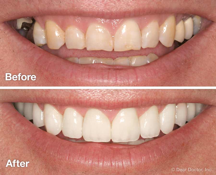 smile makeover