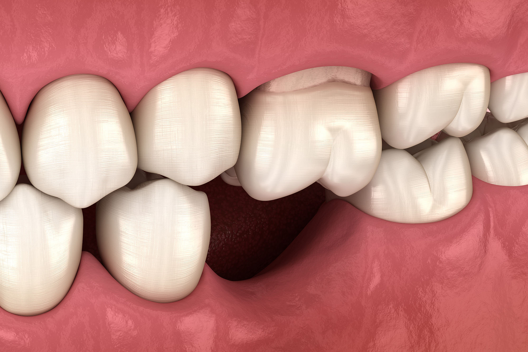 stages of a loose tooth in adults